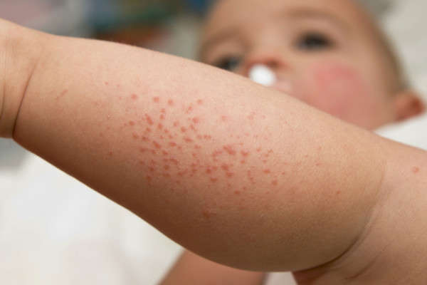 eczema on baby #10