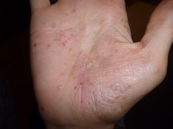 Disidrosi alle mani: come curarla